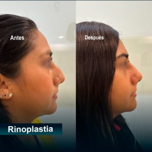 Caso rinoplastia exitoso