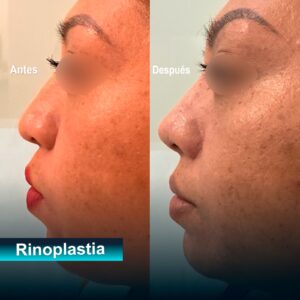 Caso de rinoplastia estética 2