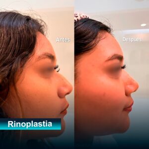 Rinoplastia