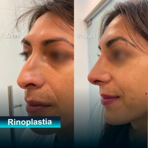 Rinoplastia