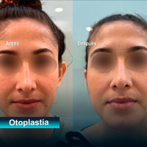Otoplastia