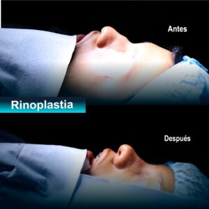 Rinoplastia estética
