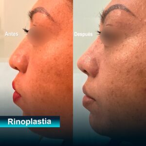 Caso de rinoplastia estética 2
